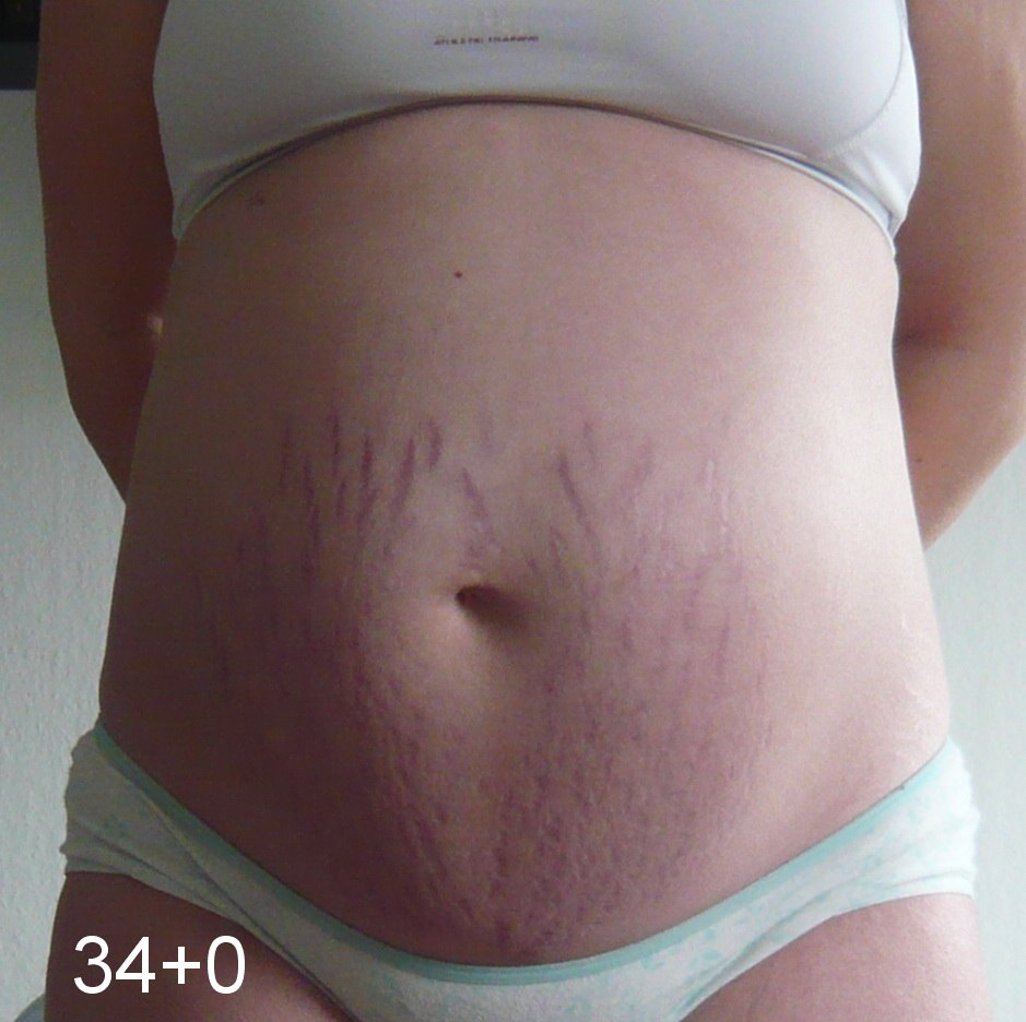 hvad er en reel vending bryster gravid hvad er en reel vending bryster gravid