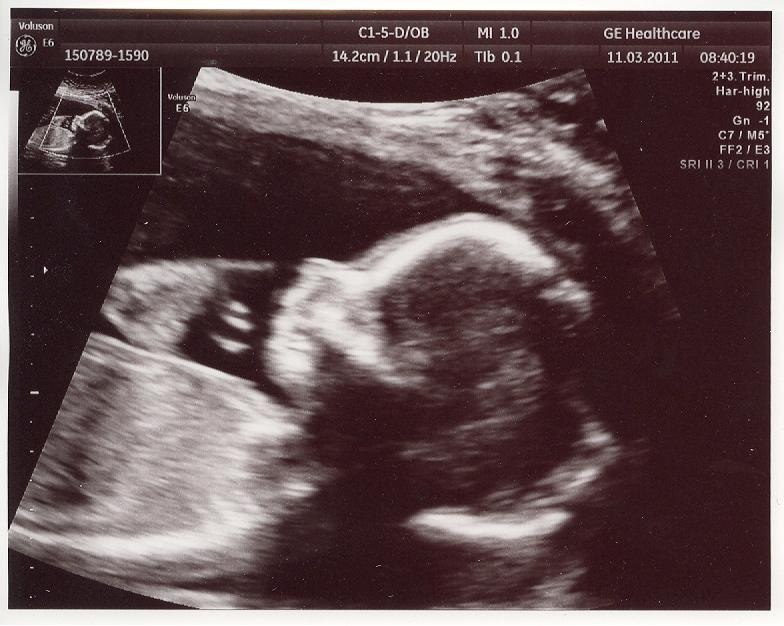 scanning gravid køn søg kæreste scanning gravid køn søg kæreste