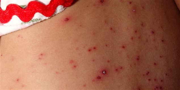 Familie i Nordsjælland ramt af mæslinger Familie i Nordsjælland ramt af mæslinger